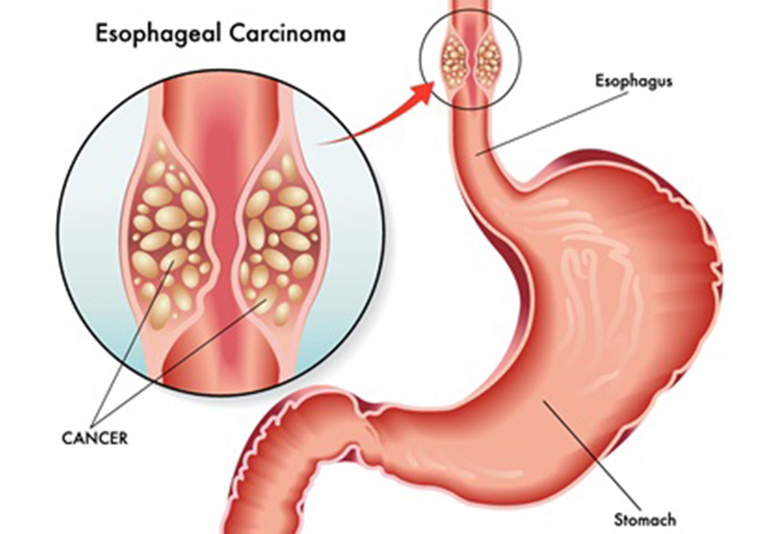 Esophageal illustration 